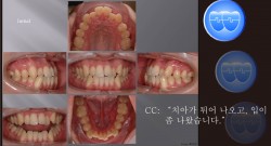 교정 Case 852.  U5L4 발치, Damon Bracket, #43 신경 죽음, Sem #12.3