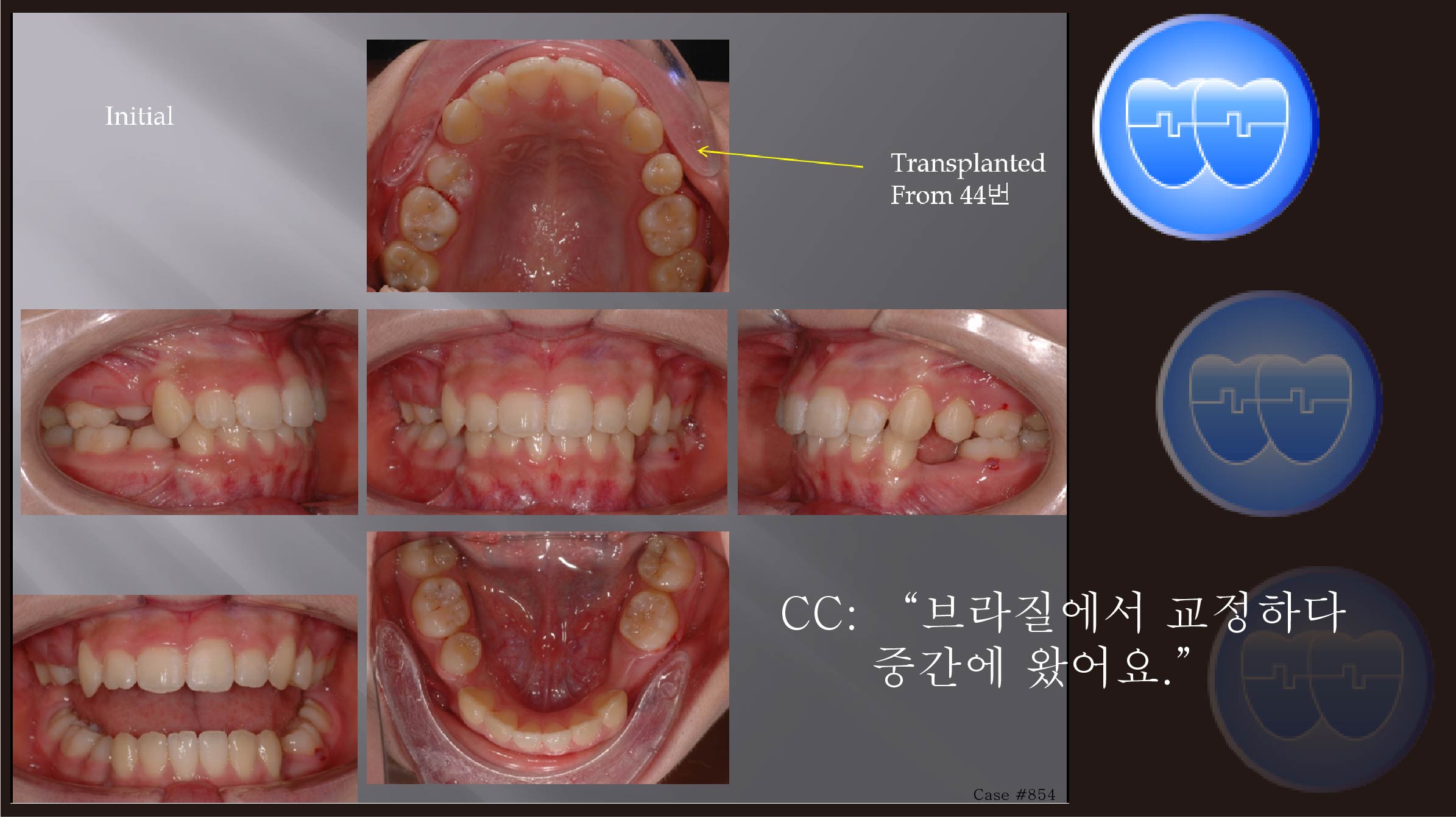 교정 Case 854.  U4L4 발치, 재교정, Transplantation하고 옴, Sem #12.1