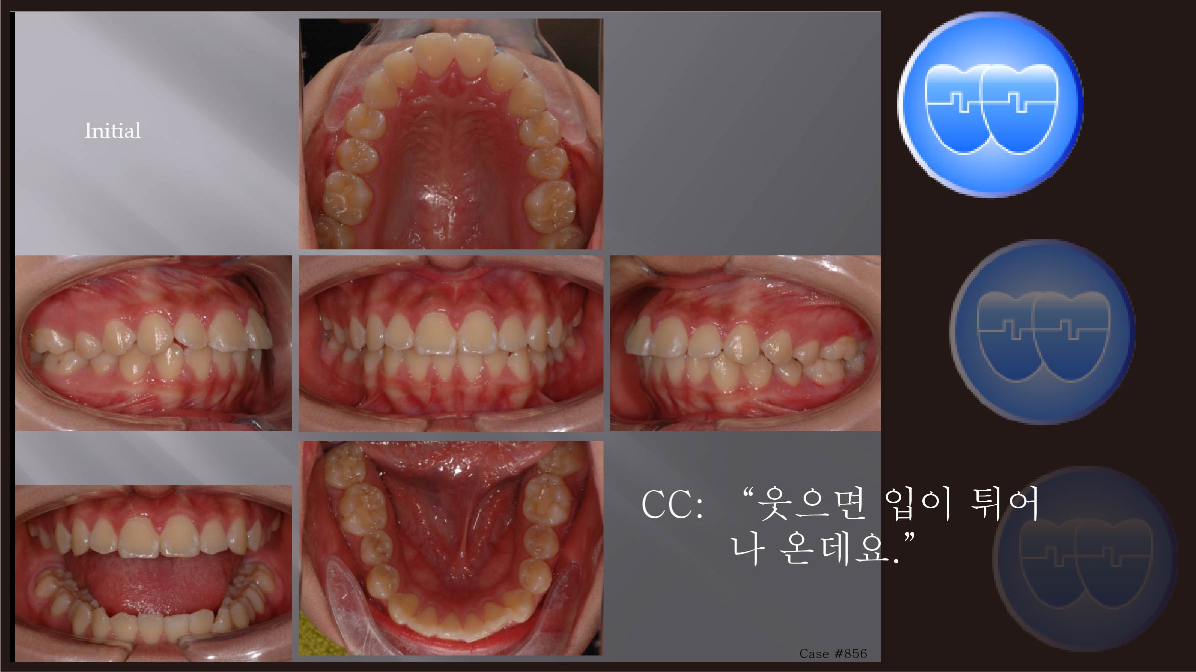 교정 Case 856.  U5L5 발치, Gummy Smile 가능성, 교정 중에 TMJ 소리(Grinding), Sem #7.5