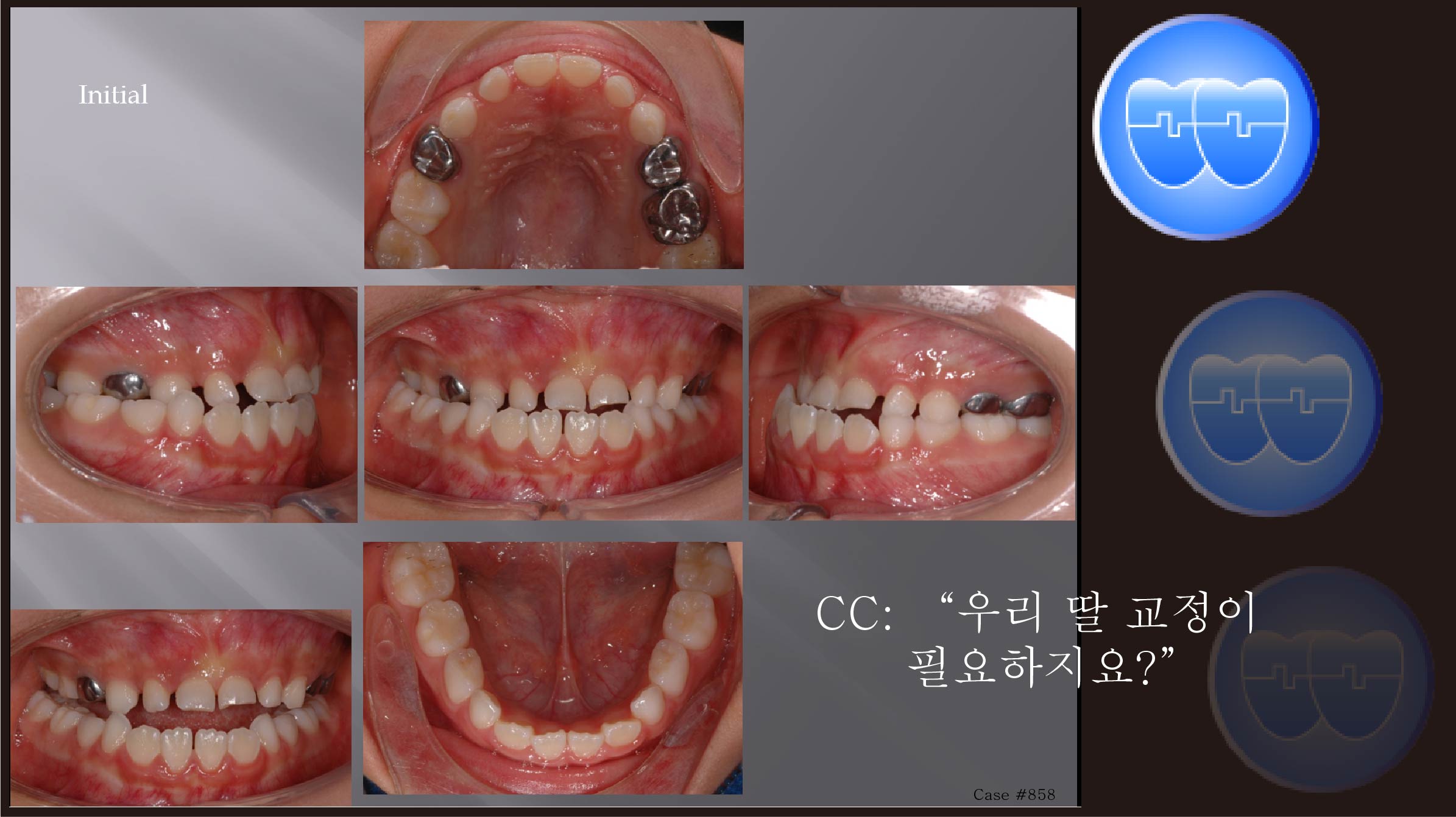 교정 Case 858.  1차 교정, Functional Shift, Anterior and Posterior Crossbite, Sem #9