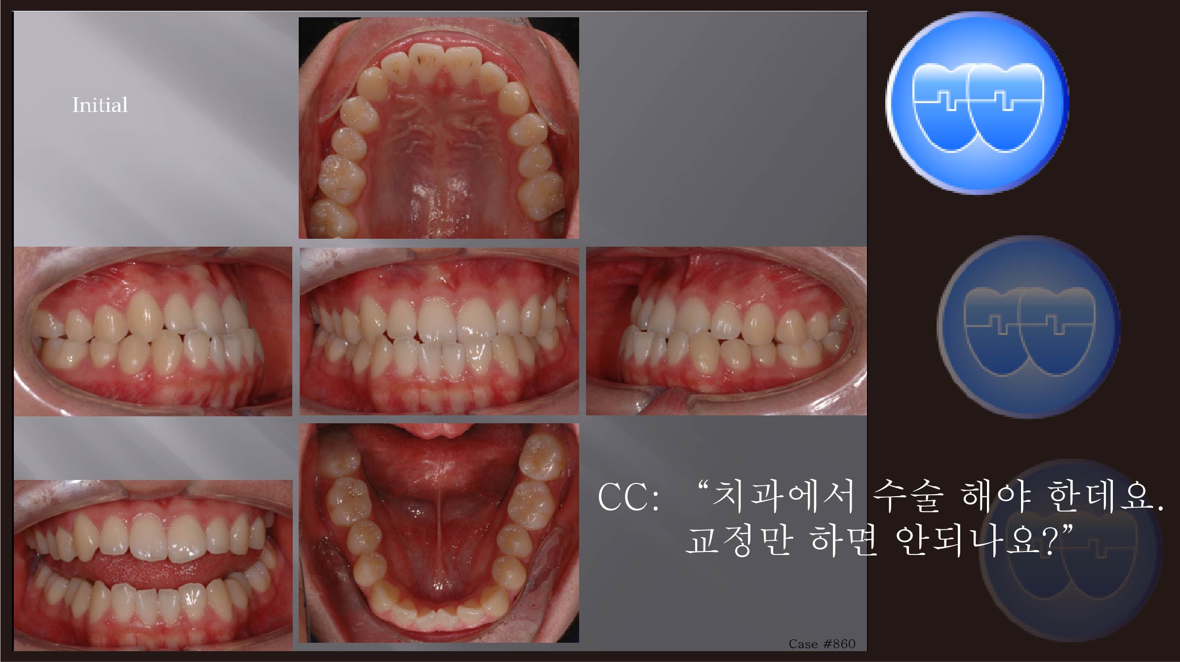교정 Case 860.  L4 발치, Functional Shift, Lower Lingual Corticotomy, Sem #7.8