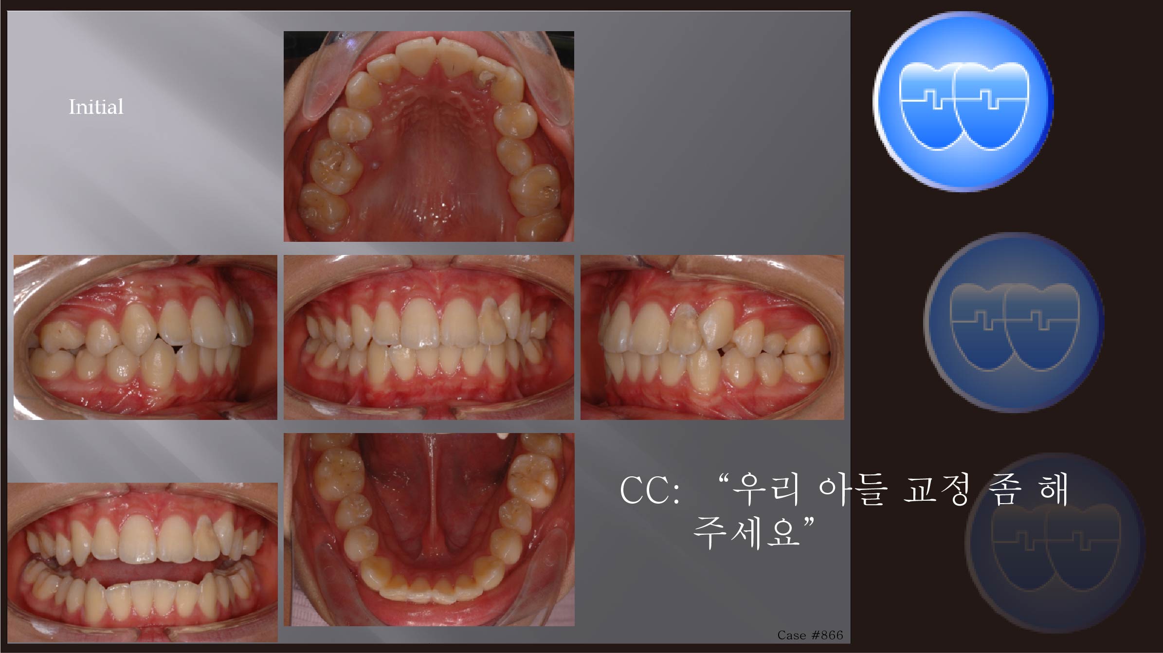 교정 Case 866.  #15, #22발치, 비대칭 발치, Midline 조심, Sem #13.2