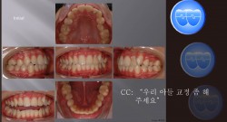 교정 Case 866.  #15, #22발치, 비대칭 발치, Midline 조심, Sem #13.2