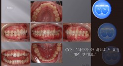 교정 Case 869.  비발치(L1 missing), Impacted Upper Canine, Root Resorption, Sem #14
