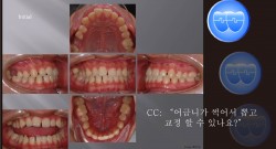 교정 Case 879.  비대칭 발치, #16 발치, Low Sinus, Sem #13.2
