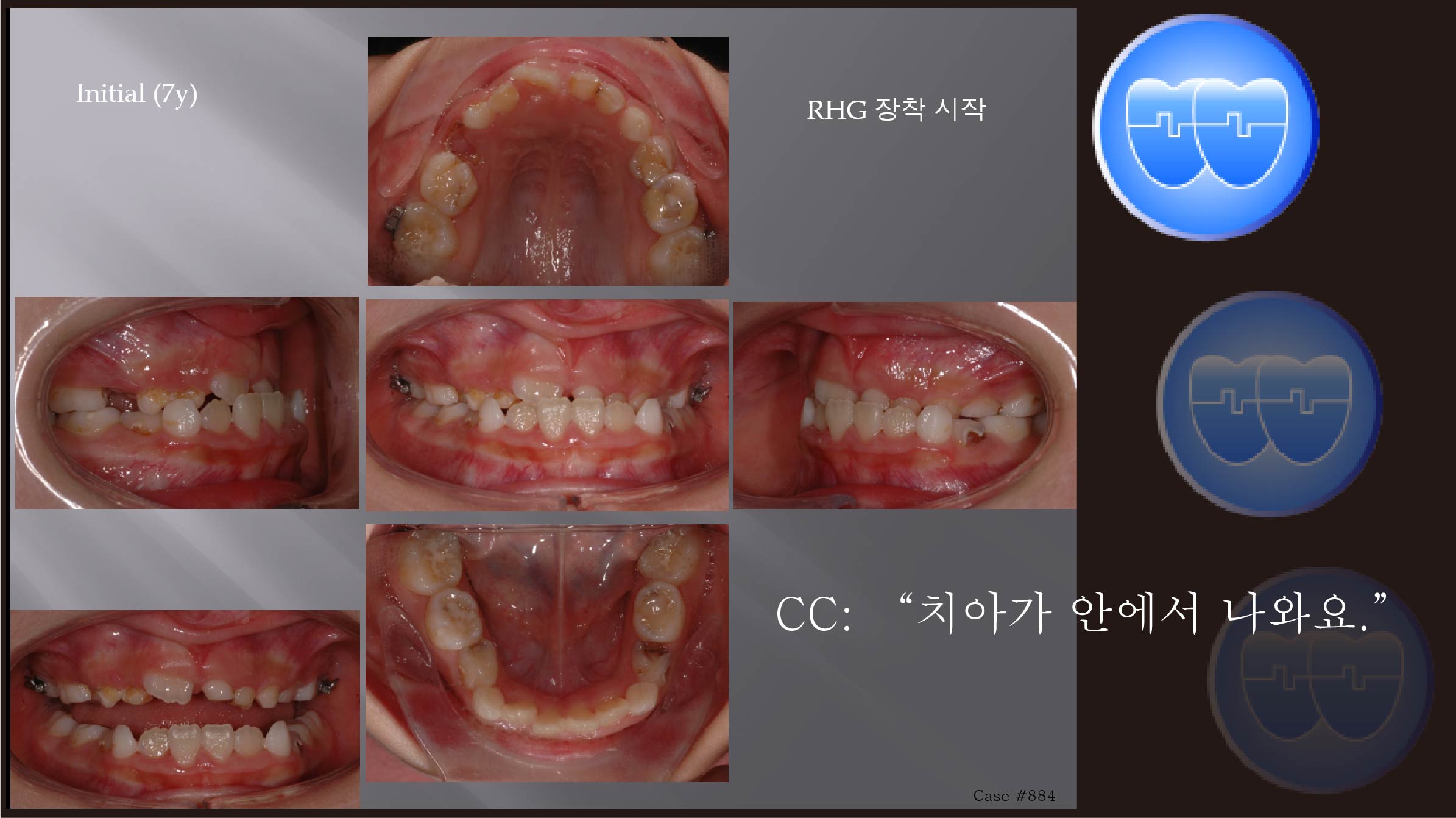 교정 Case 884.  1차 교정, RHG, Sem #9