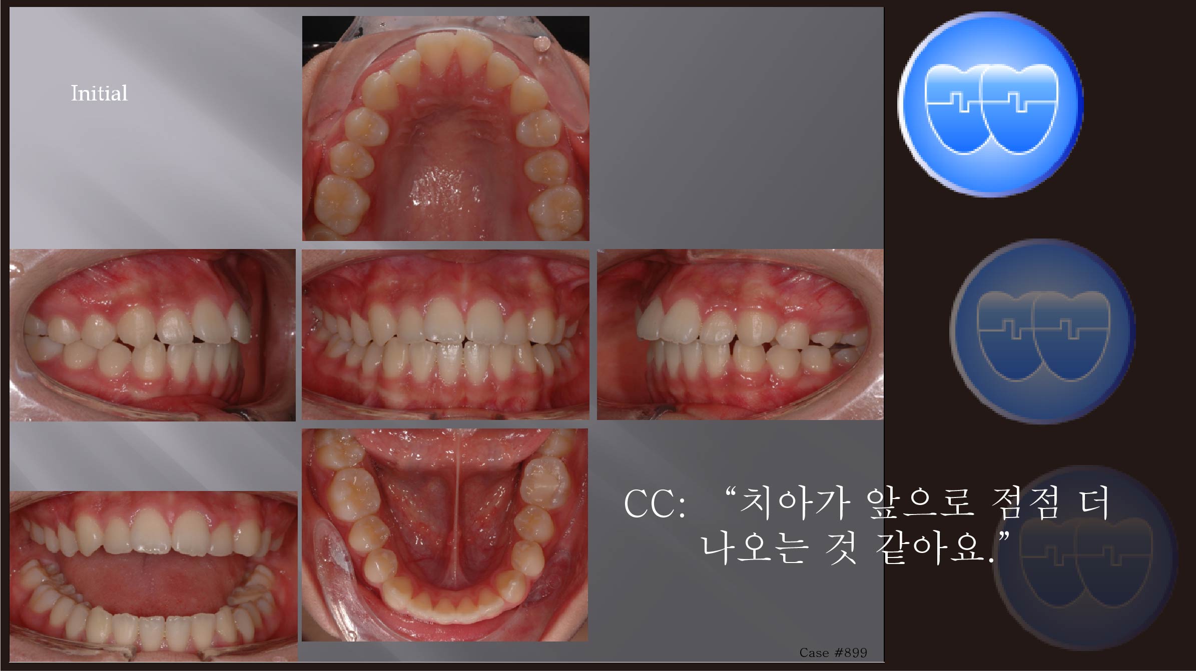교정 Case 899.  U5 발치, Class II, Moderate Protrusion with Overjet, Sem #12.6