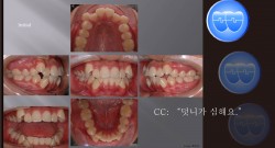 교정 Case 901.  U4L4 발치, Severe Crowding, Finishing with Wire Bending, Sem #12.1