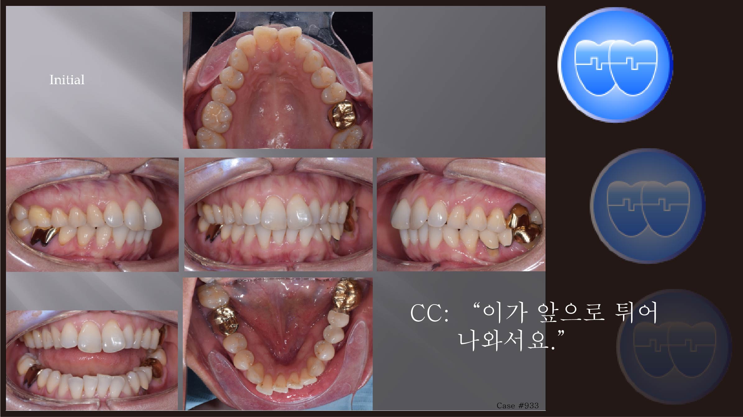 교정 Case 933.  비대칭 발치, 성인, Upper Palatal Corticotomy, Sem #13.2