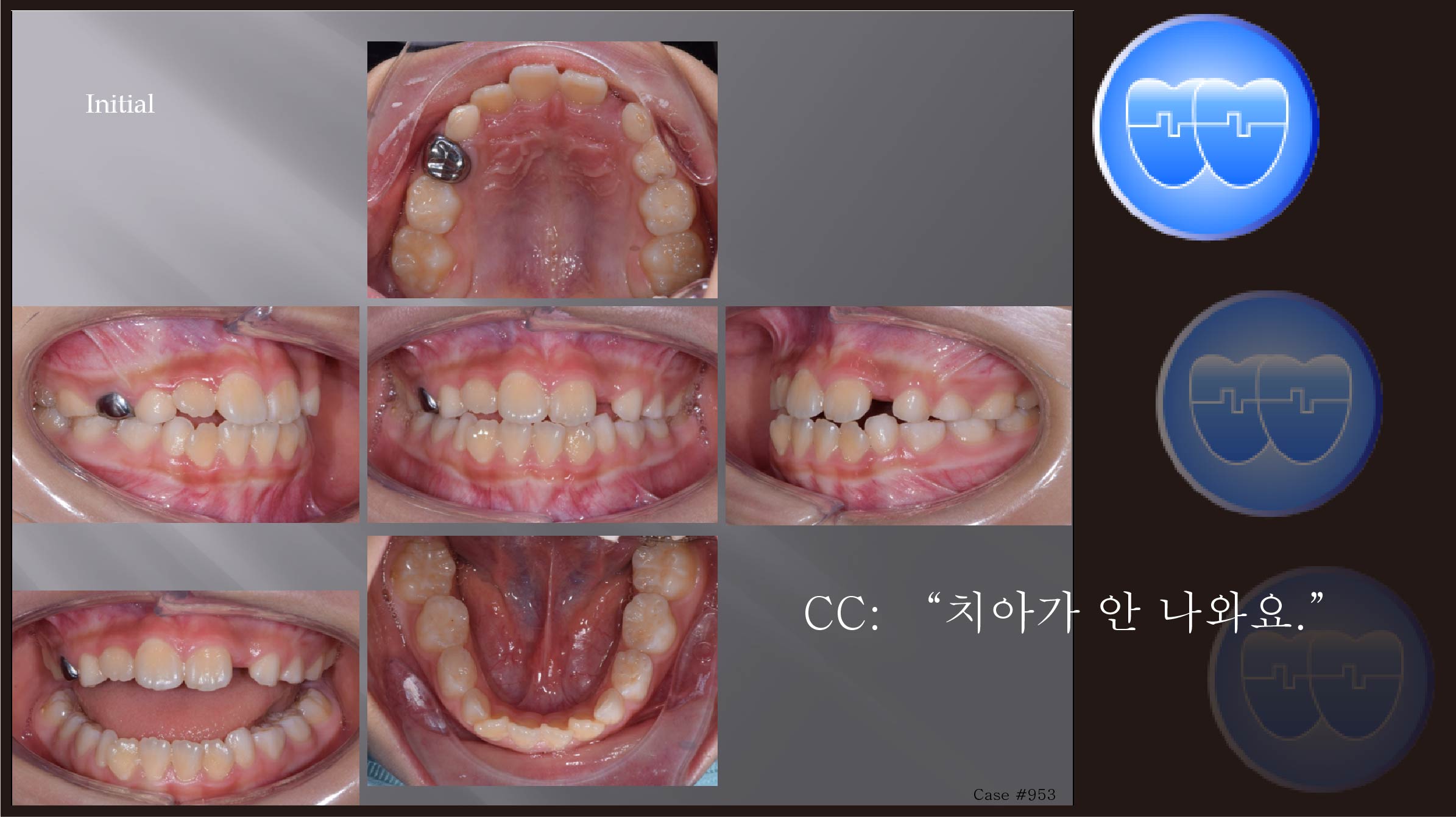 교정 Case 953.  1차 교정, Impaction of #22, Sem #9
