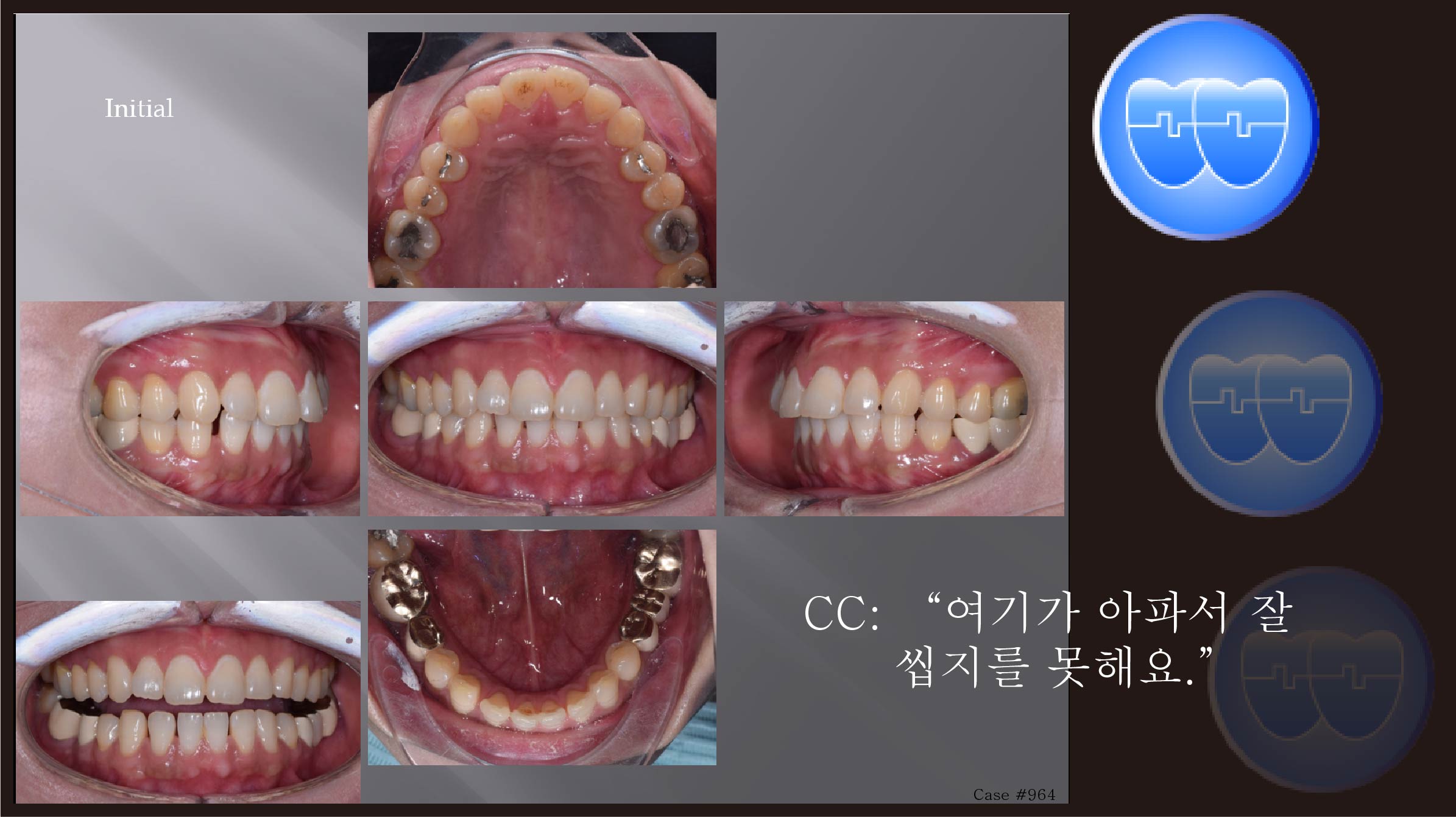 교정 Case 964.  비발치, Anterior Lower Space, Prosth-Ortho, Sem 20.5