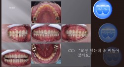 교정 Case 970.  재교정, Tilted Occlusal Table Correction, Sem #7.7