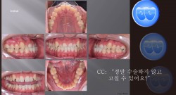 교정 Case 983.  L4 발치, Class III,  Lower Lingual Corticotomy, Arch Coordination, Sem #7.8