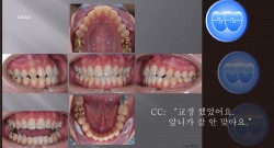 교정 Case 991.  L1 발치, Class III, Midline, Functional Shift, Lower Lingual Corticotomy, Sem #13