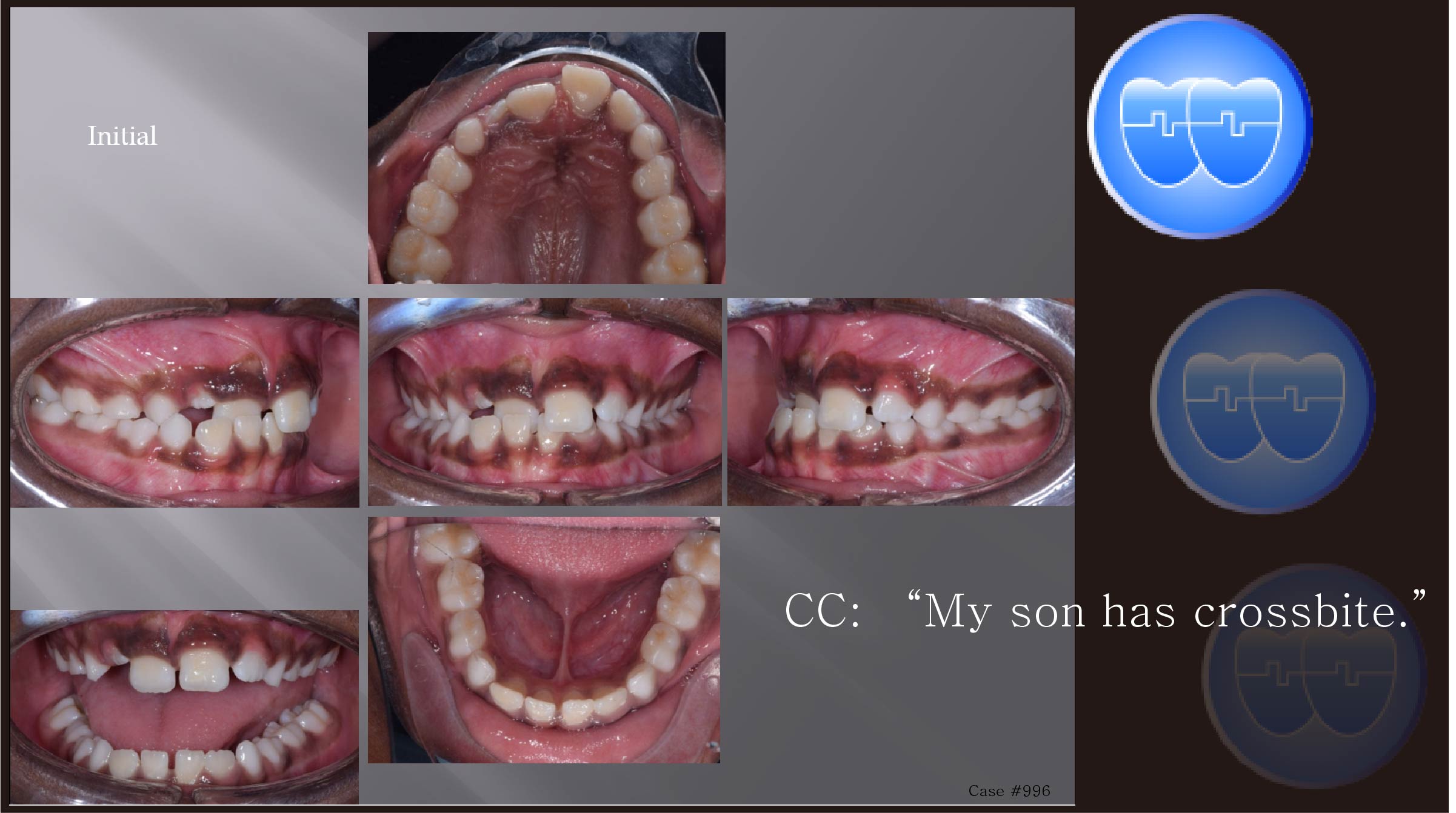 교정 Case 996.   1차 교정, Anterior Crossbite, 시갈 버튼, Sem #9