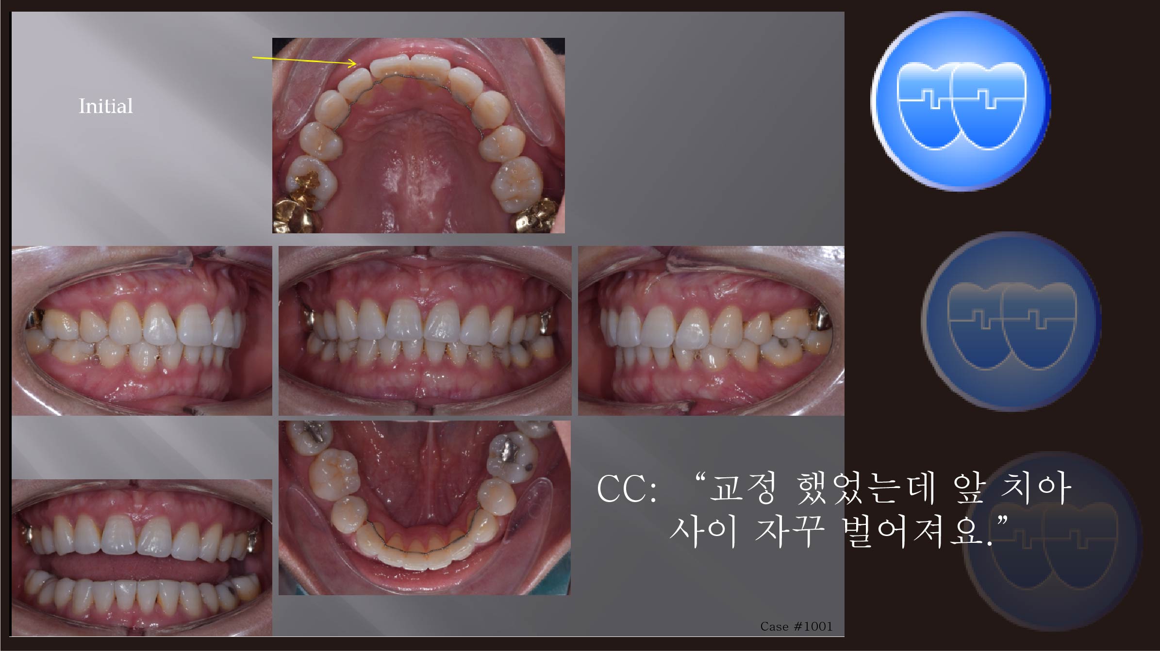 교정 Case 1001.  U4L4 발치, 재교정, Root Resorption, Concave Profile, Sem #10