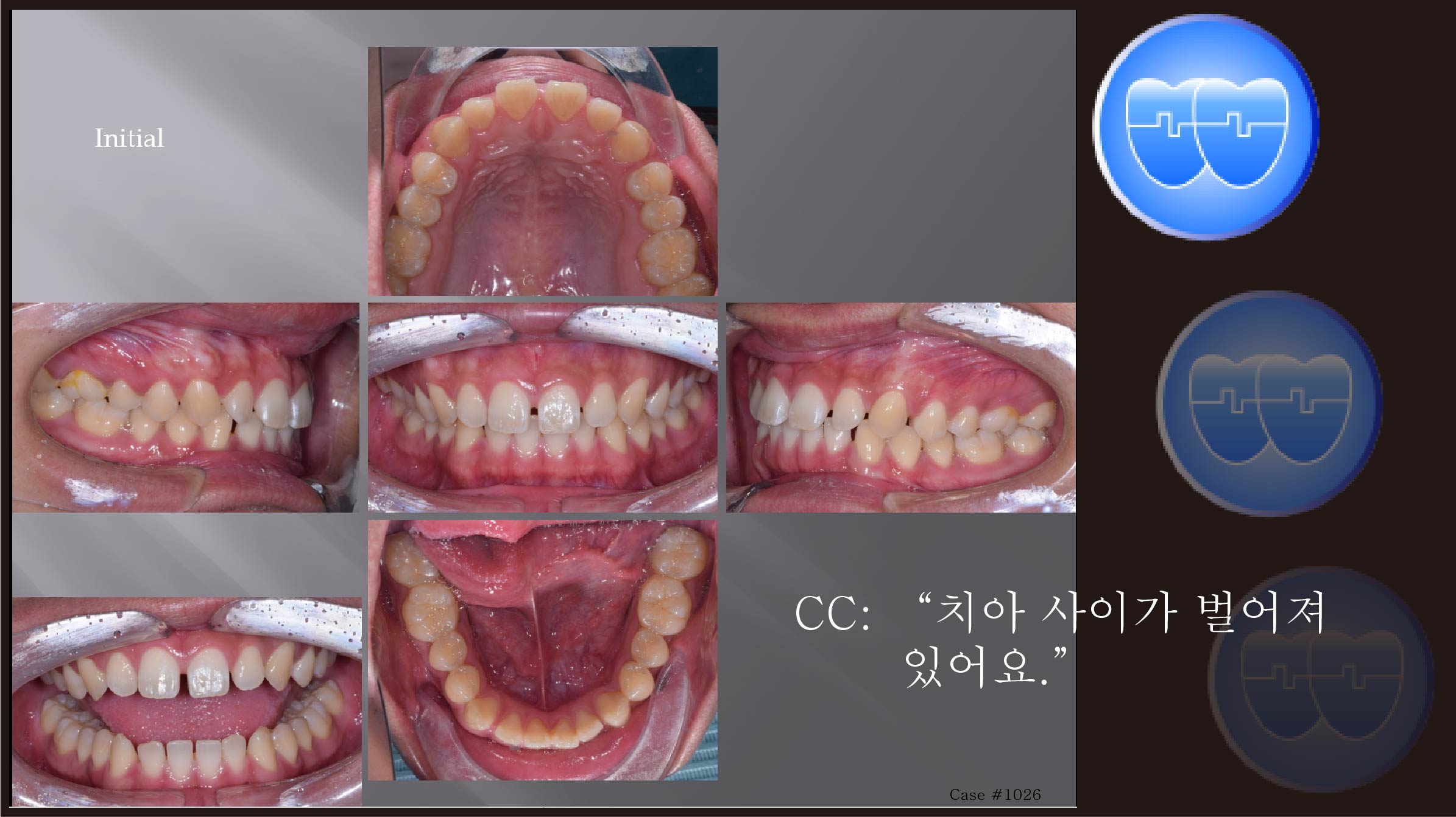교정 Case 1026.  비발치, Anterior Space Closure, 턱빠짐, Friction Control, Sem #5