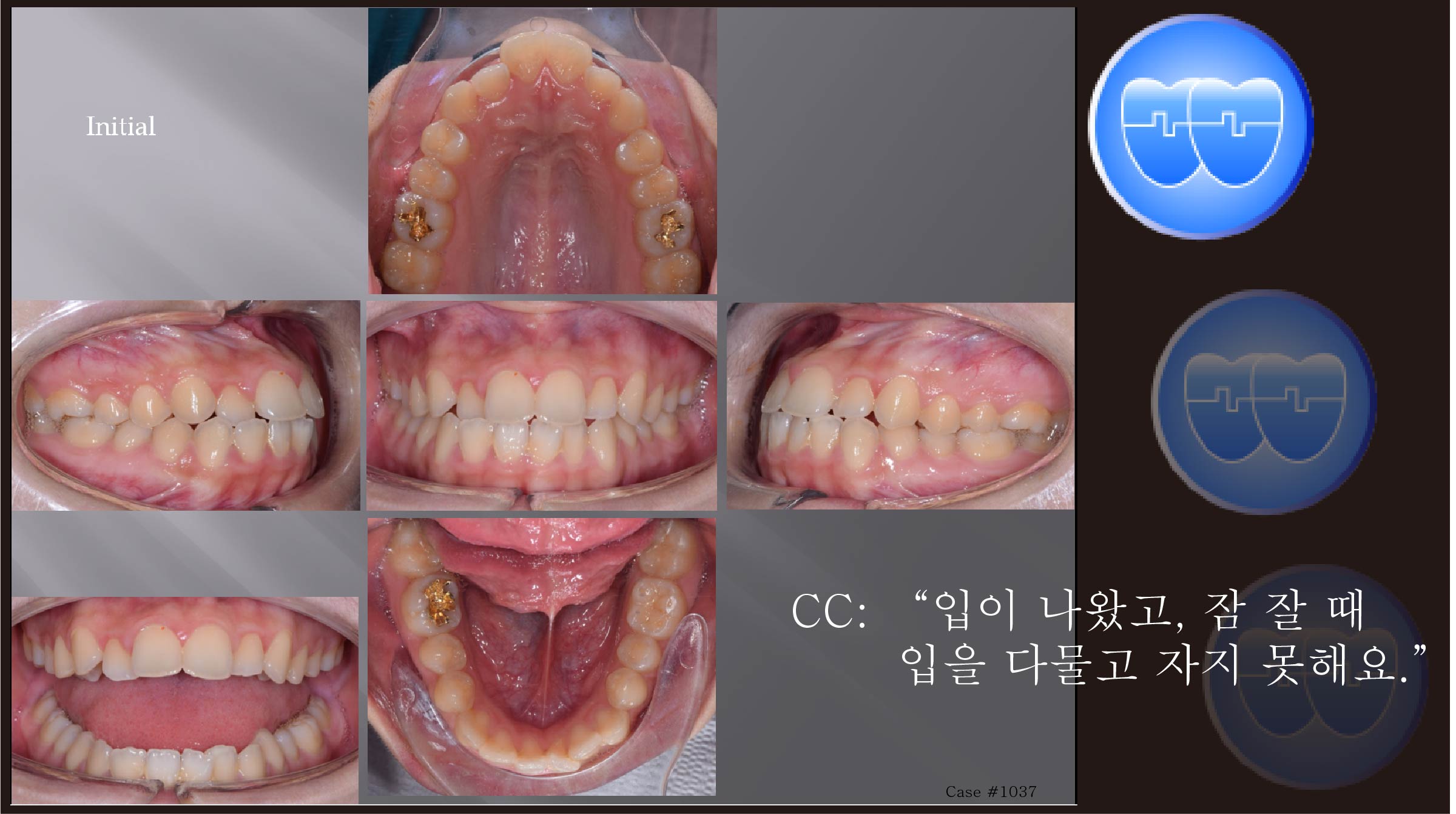 교정 Case 1037.  U5L4 발치, Skeletal Resistance, Lower Lingual Corticotomy, Torque Complication, Sem #13.7