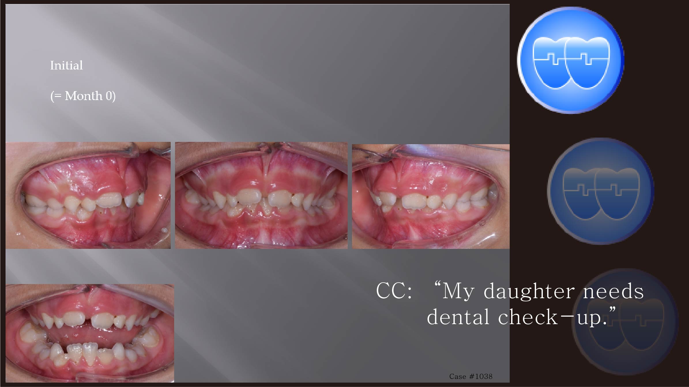 교정 Case 1038.  1차 교정, Upper Molar Distalization, Sem #9