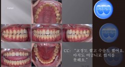 교정 Case 1066.  재교정, 비발치, Lower Lingual Corticotomy, Bilateral Posterior Crossbite, Sem #7.8