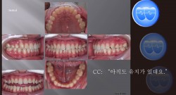 교정 Case 1086.  L1 발치, Congenital Missing Lower Incisors, Sem #13