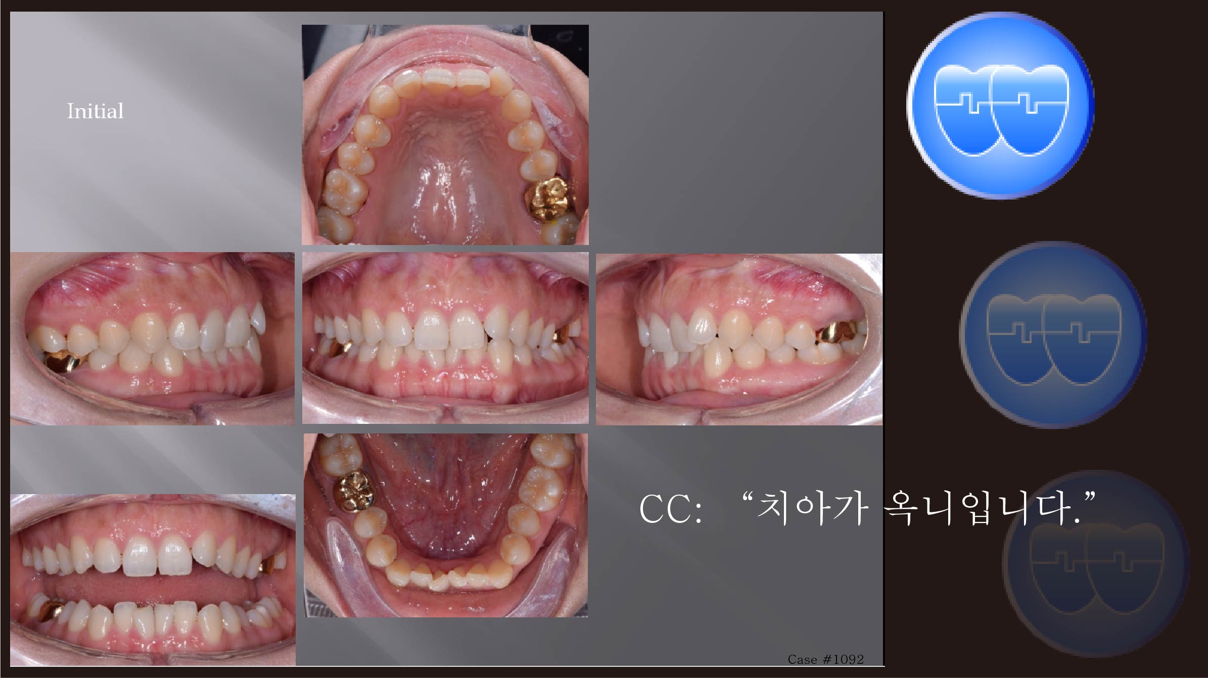 교정 Case 1092.  비발치, Class II Div. 2, Detorqued Anterior Teeth, Deepbite, Sem #2