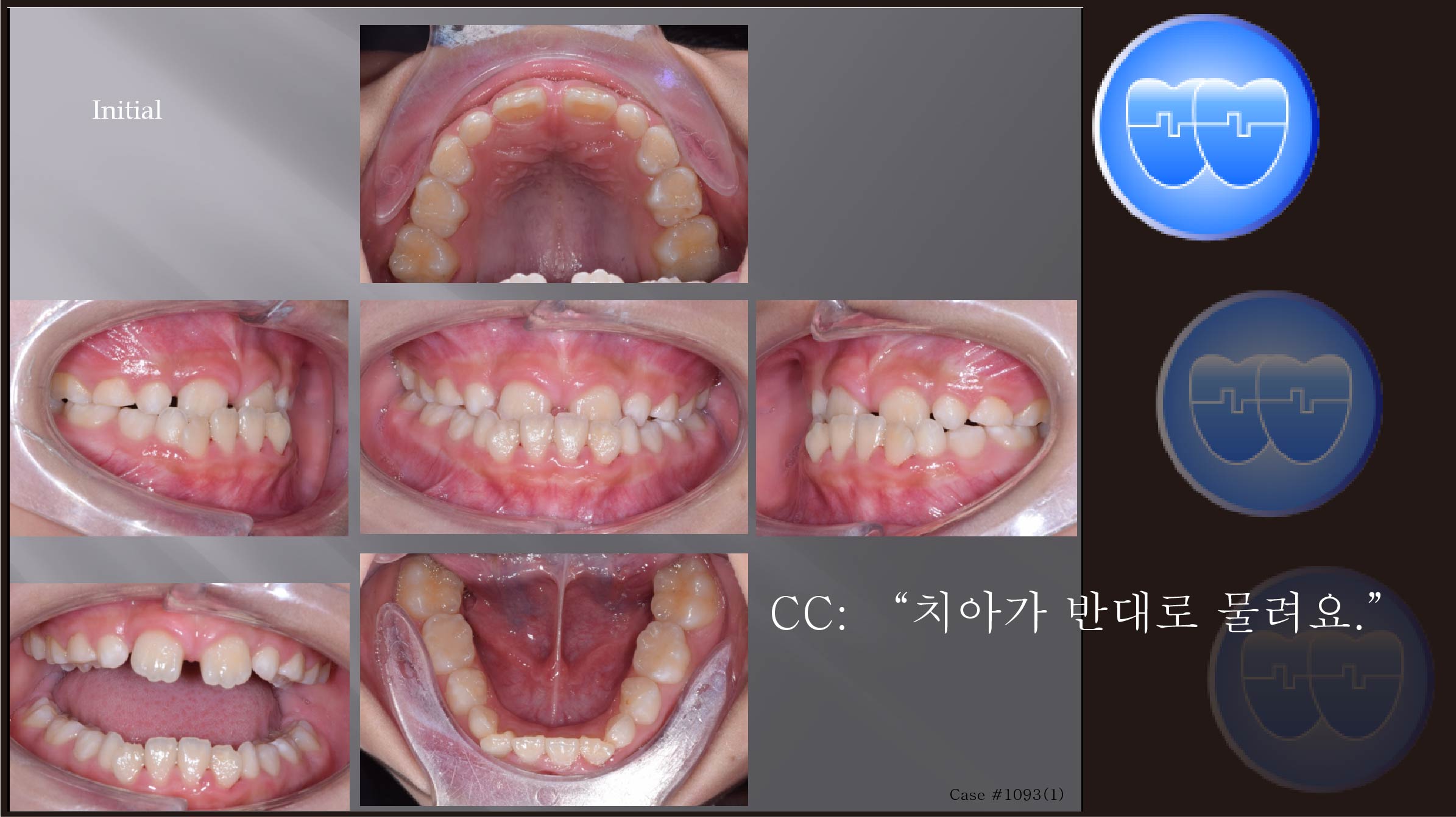 교정 Case 1093(1).  1차 교정, RHG, Sem #12