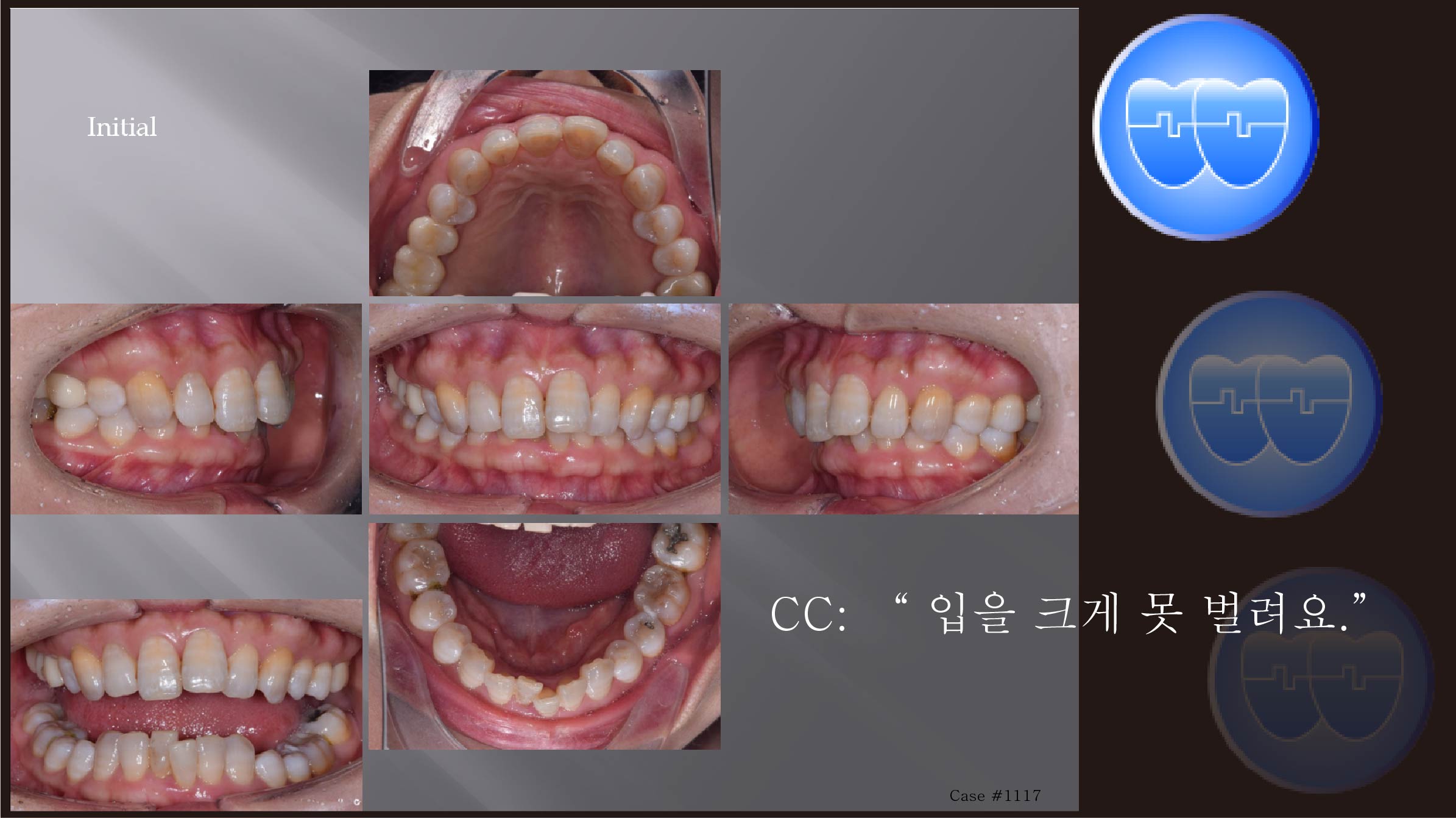 교정 Case 1117.  비발치, TMJ, Deepbite, Sem #19