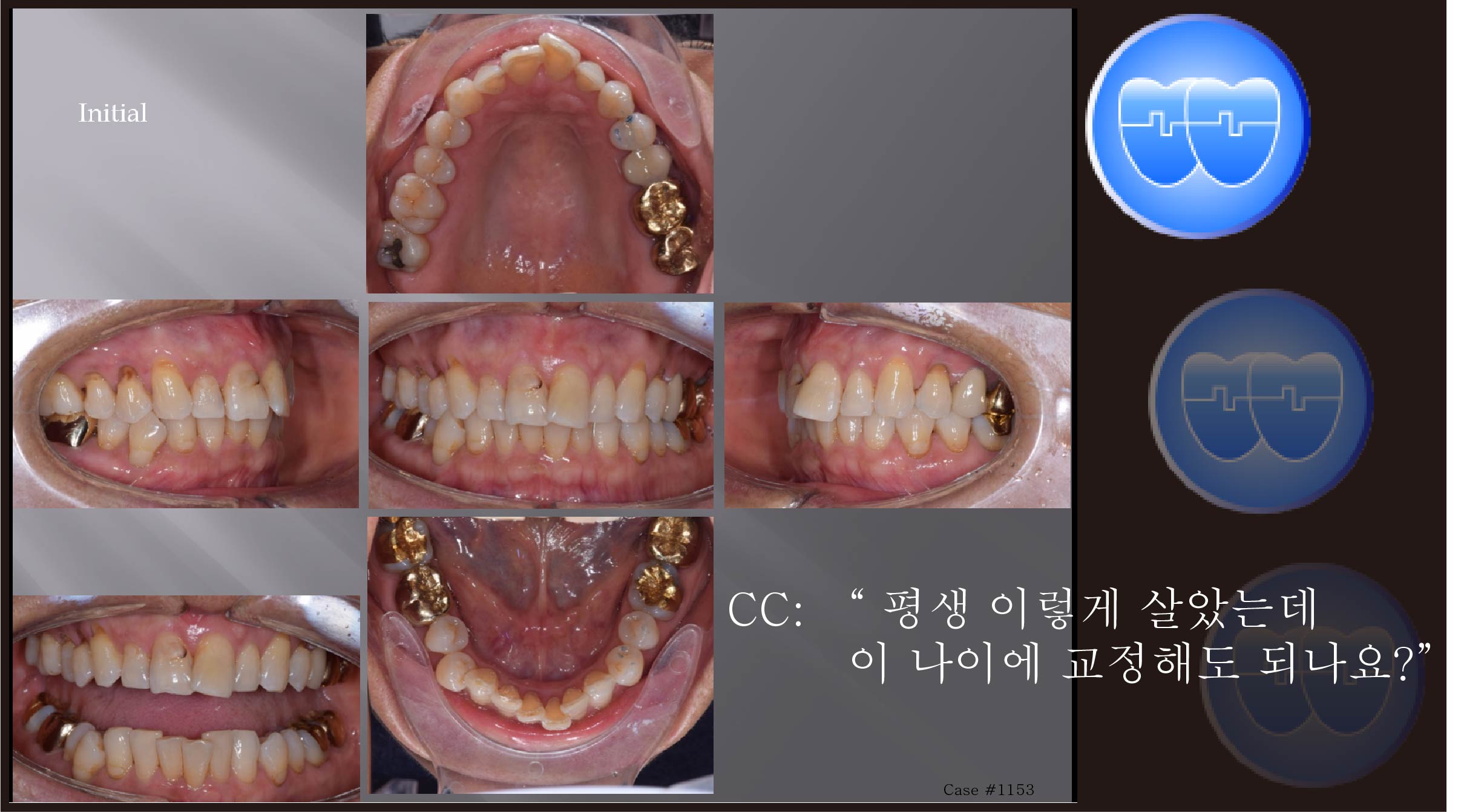교정 Case 1153.  부분교정, 성인교정, Anterior Crowding, Sem #5