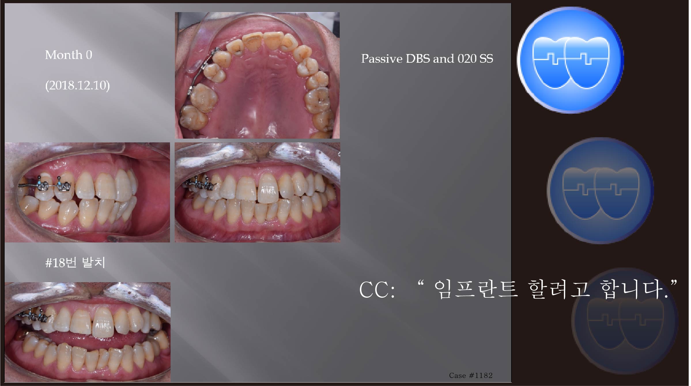 교정 Case 1182.  부분교정, Space Gaining for Implant #15, Sem #20.5