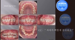 교정 Case 1217.  1차 교정, Lower Crowding, #12 Crossbite, Sem #9
