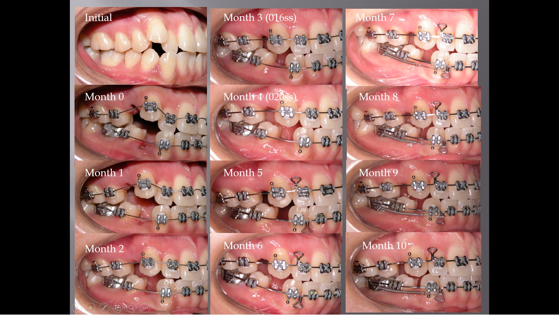 (강의 11) Sem #3 : Bracket, Band, Archwire (Part 3)