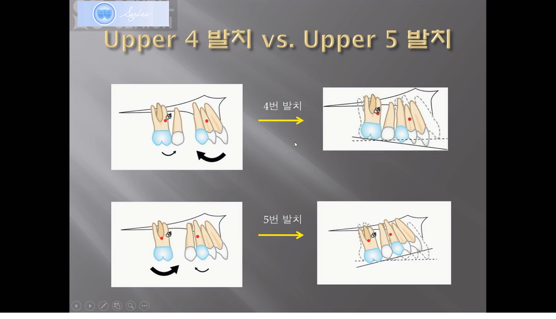 (강의 18) Sem #6 : Dental Deepbite (Part 1)