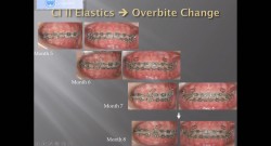 (강의 18) Sem #6 : Dental Deepbite (Part 2)