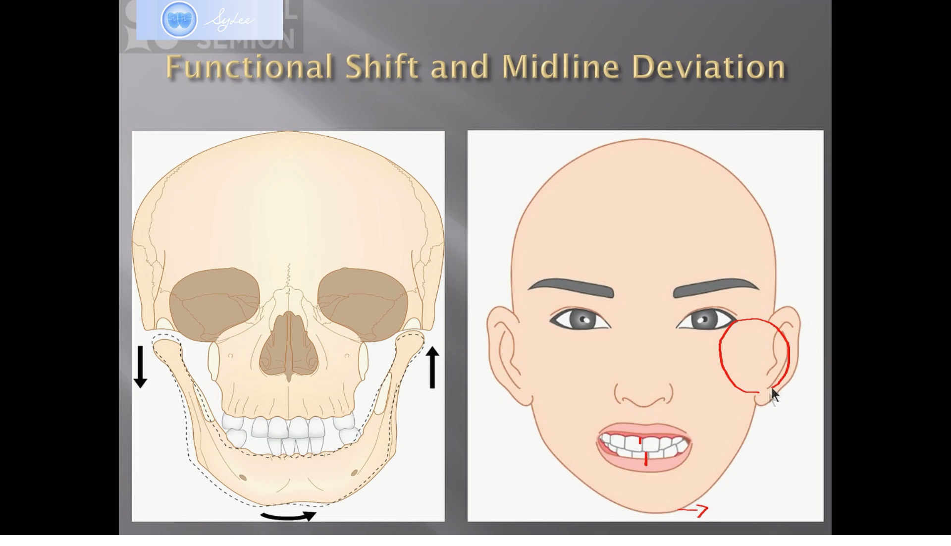 (강의 19) Sem #6 : Functional Shift와 Dental Midline (Part II)