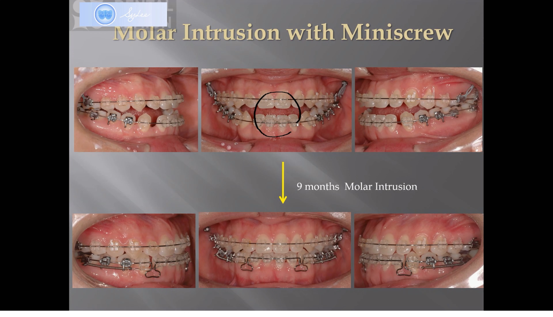 (강의 20) Sem #7 : Dental Openbite