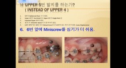 (강의 21) Sem #10.5 :  5번 발치의 장점 (Part 1)