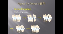 (강의 27) Sem #10 Extraction (Part 2) - U4L4 발치