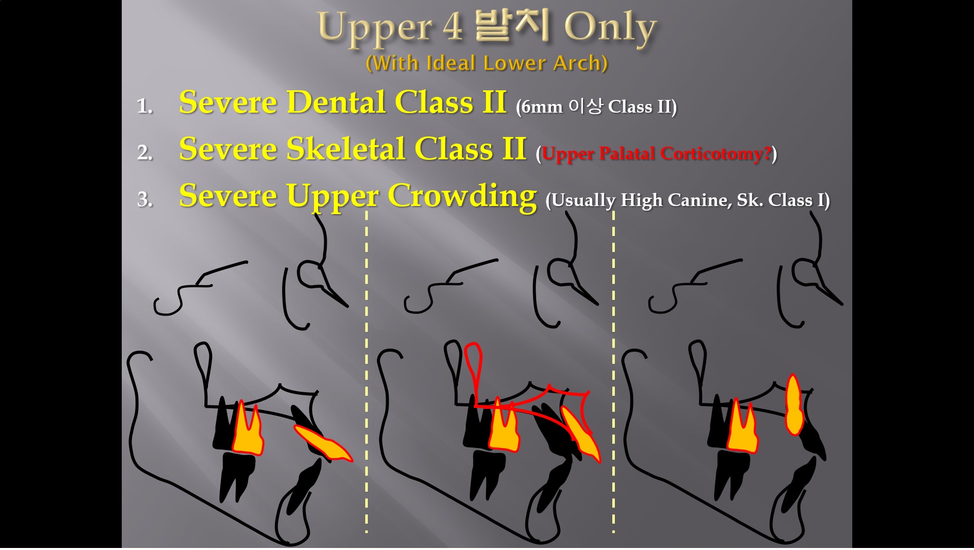 (강의 27) Sem #10 : Extraction (Part 6) - U4 발치 Only