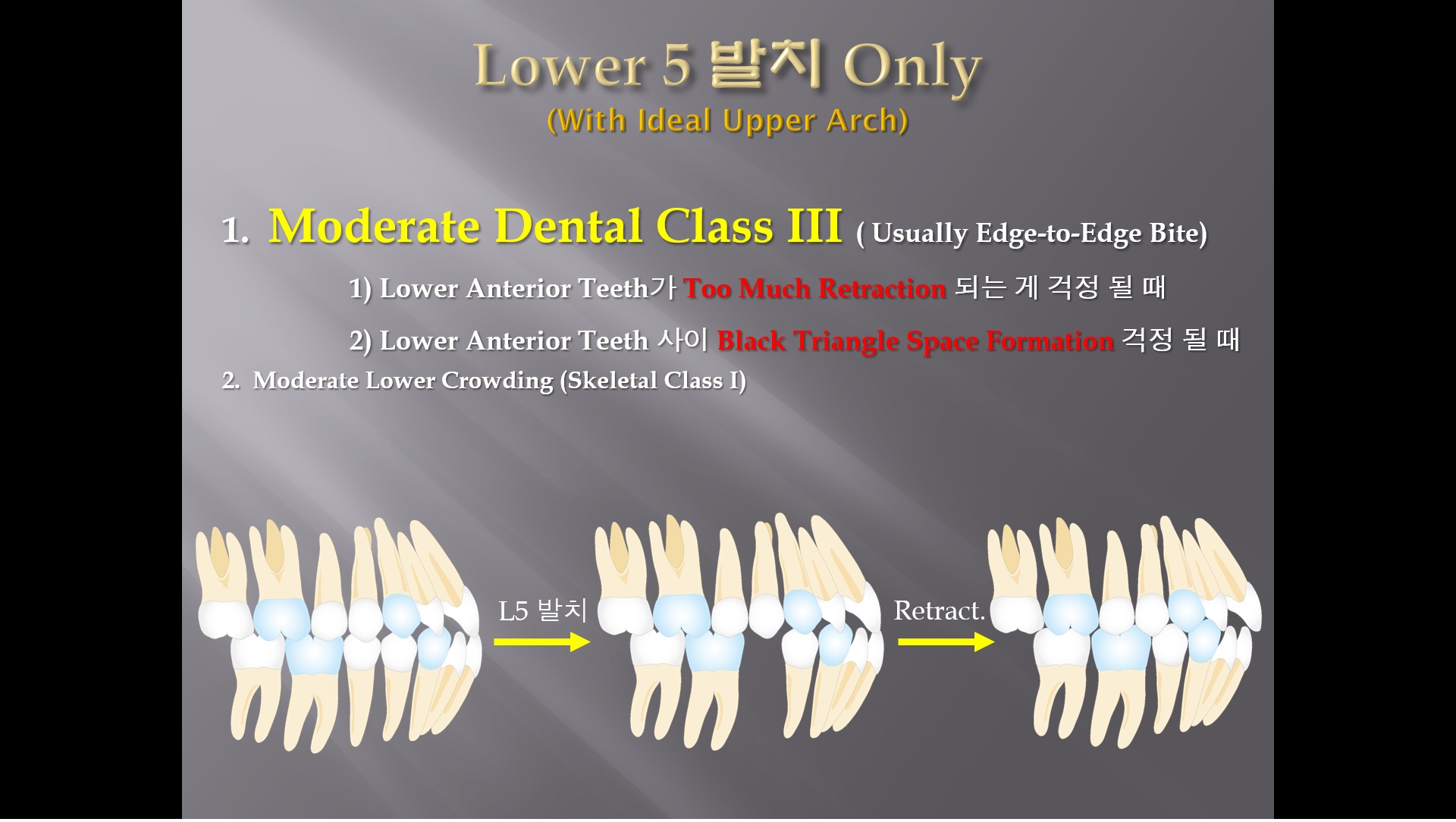 (강의 27) Sem #10 : Extraction (Part 9) - L5 발치 Only