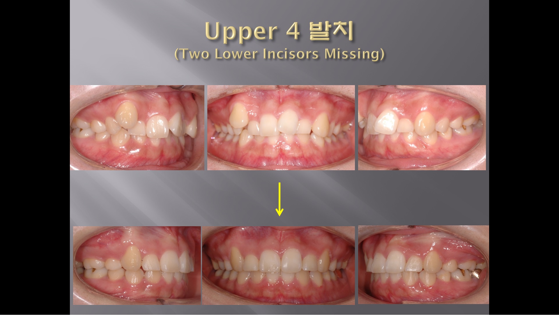 (강의 27) Sem #10 : Extraction (Part 14) - Lower Anterior Teeth 발치