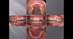 (강의 29) Sem #11 : Tooth Size and Arch Size Discrepancies (Part 2)