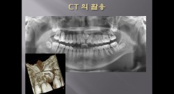 (강의 34) Sem #14 : Retrieval of Impacted Teeth (Part 3)