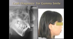 (강의 90) Sem #7.5 : Gummy Smile (Part 1-2)