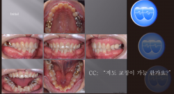 교정 Case 1246.  L1 발치, Lower Crowding, 성인교정, 부분교정, Sem #13