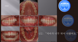 교정 Case 768.  U5 발치, Severe Overjet, Dental Midline, Vertical Grower, Sem #12.6