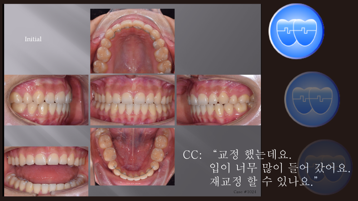 교정 Case 1024.  재교정, Retraction된 profile을 고치기 위해서, Sem #10
