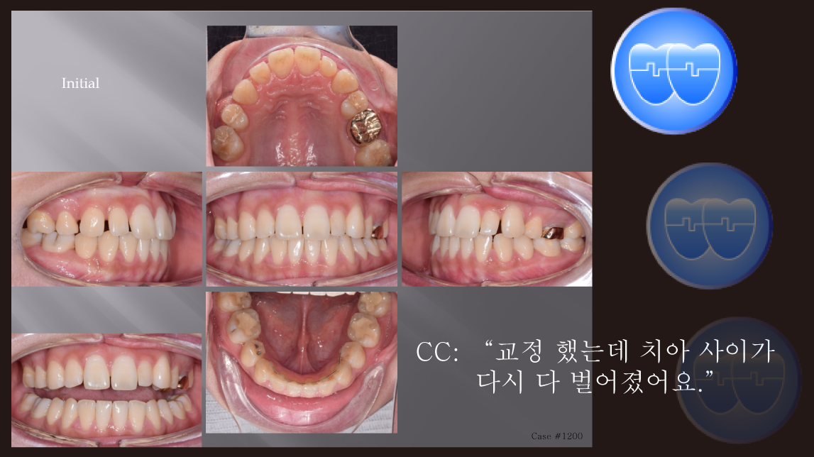 교정 Case 1200. 재교정, Prosth-Ortho., Sem #20.5