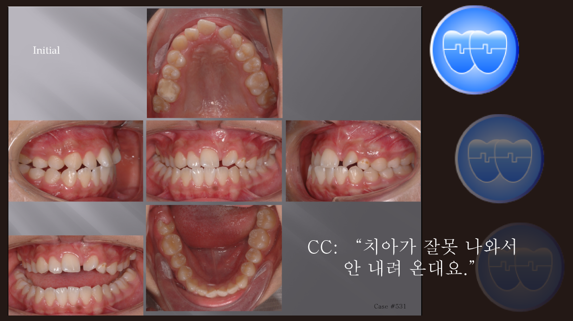 교정 Case 531.  비발치, Two Impacted Teeth #11 and #13, Sem #14