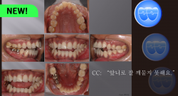교정 Case 662.  비대칭 발치(15, 22, 36, 47번 발치), Sem #7